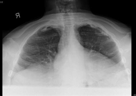 chest x ray apicolordotic view|Apical zone .